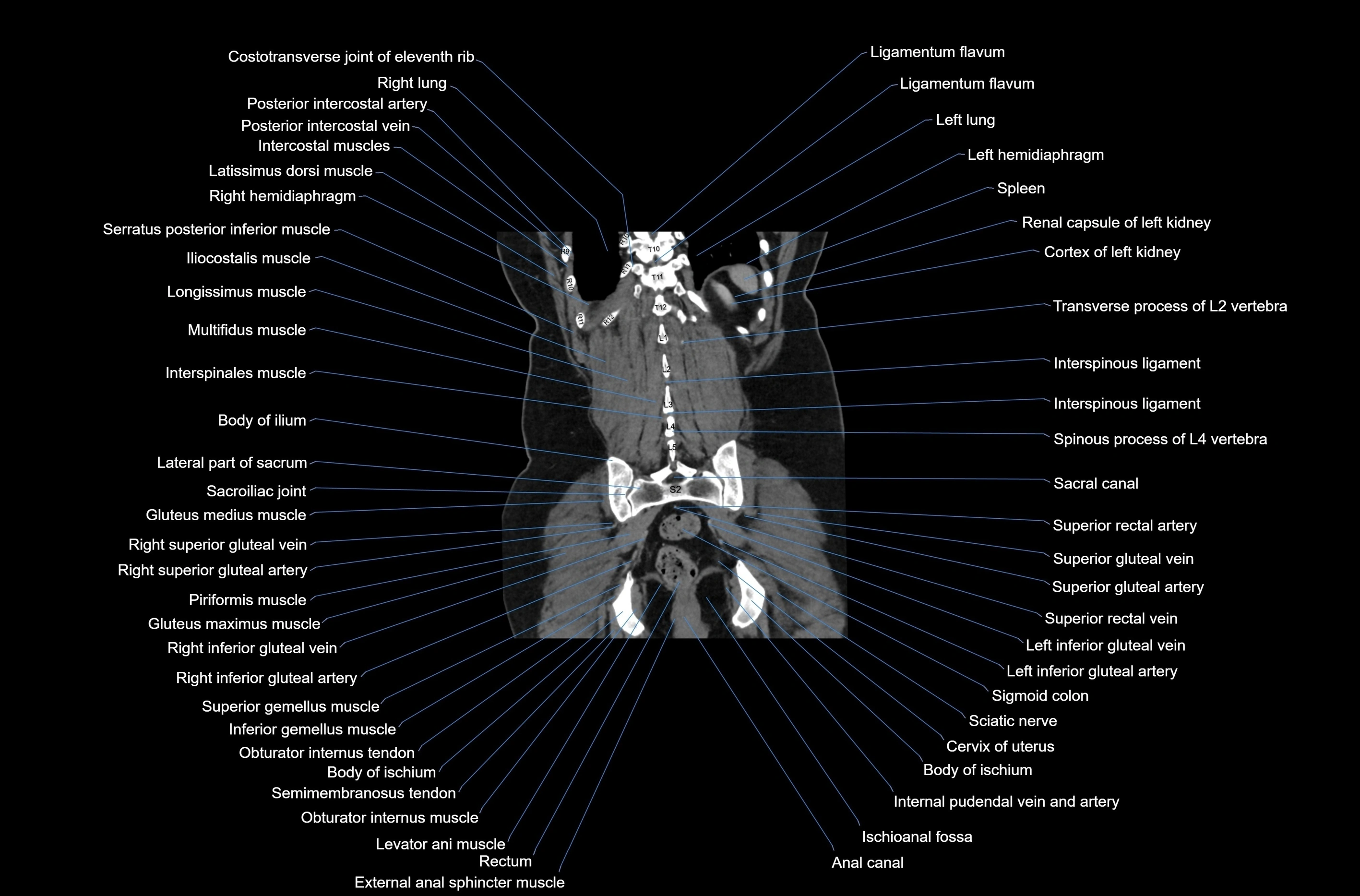 CT abdomen coronal cross sectional anatomy labelled radiology image-00069.webp